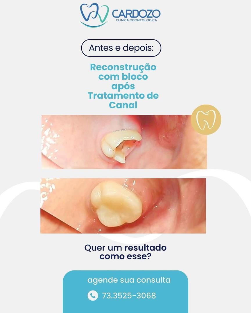 Reconstrução após tratamento de canal
