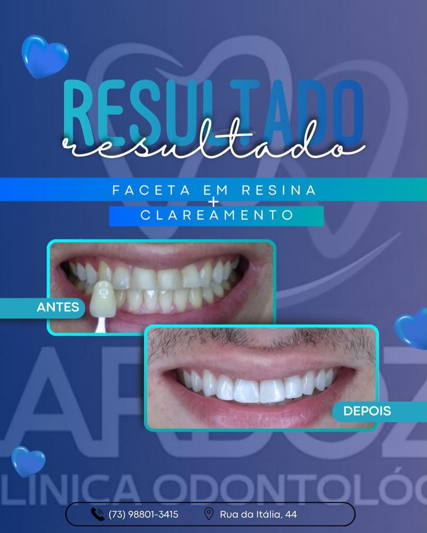 Antes e depois: faceta em resina e clareamento