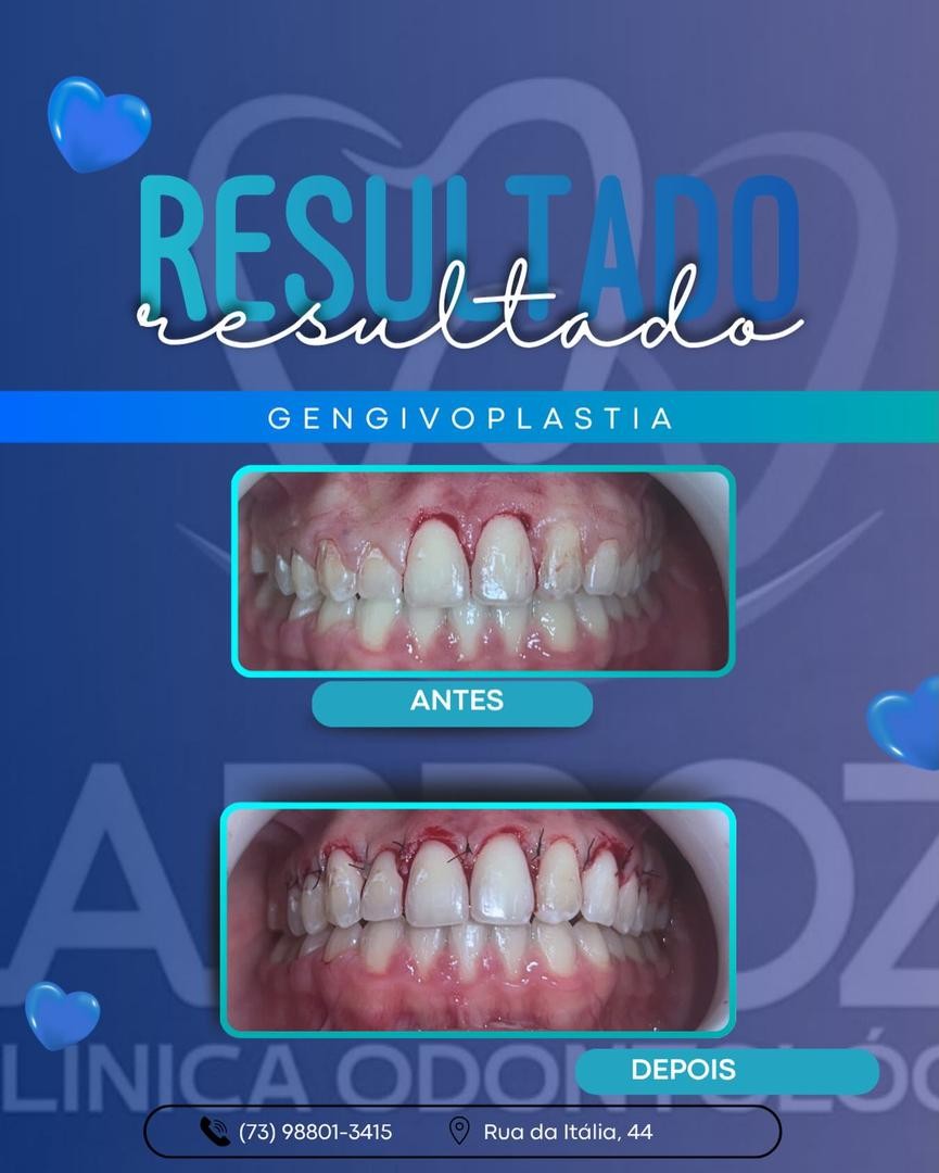 Antes e depois: gengivoplastia