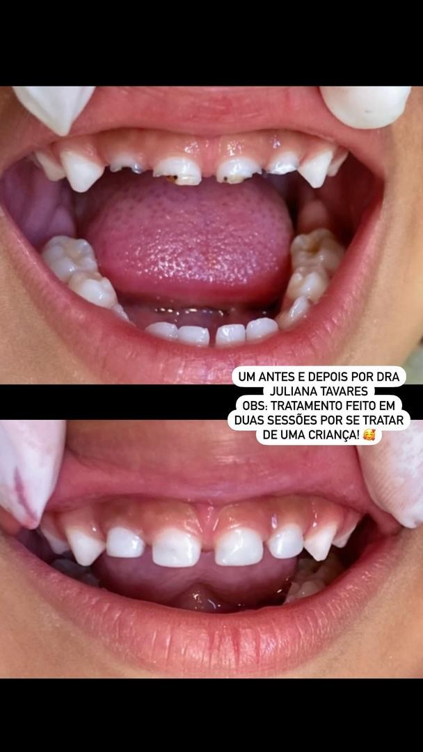 Antes e depois odontopediatria