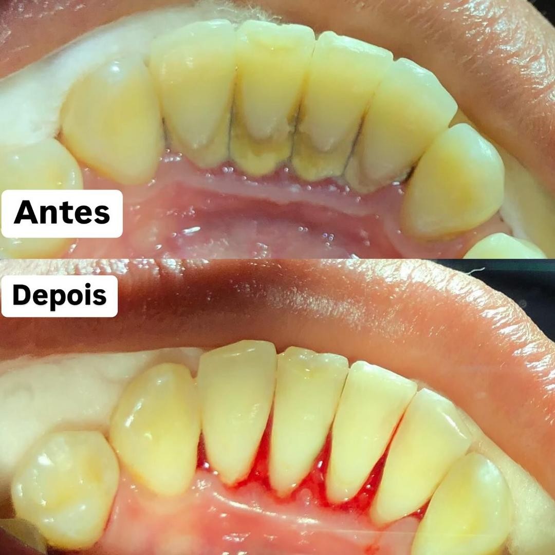 Antes e depois de limpeza