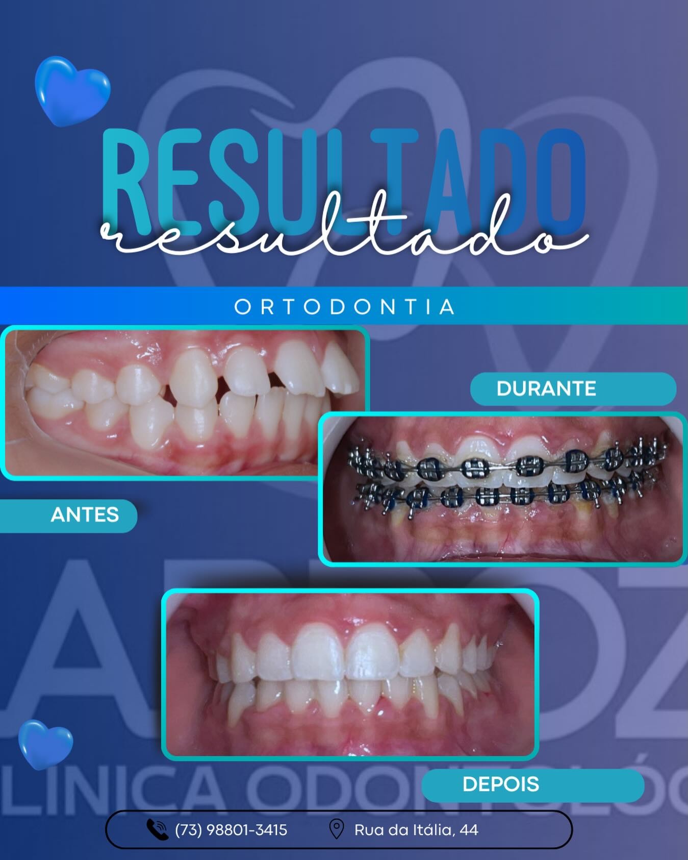 Antes, durante e depois: ortodontia