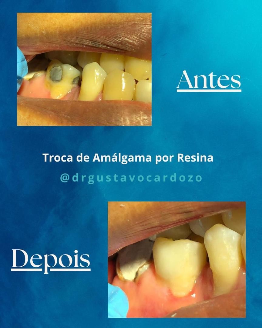 Troca de amálgama por resina