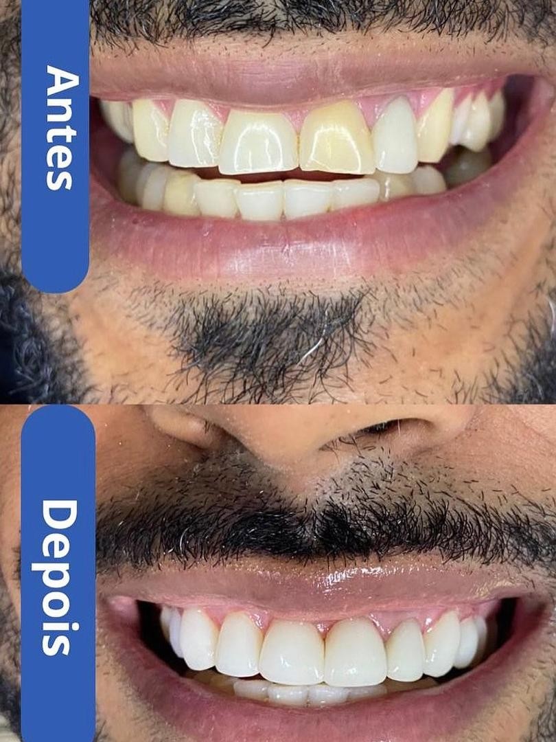 Antes e depois de sorriso